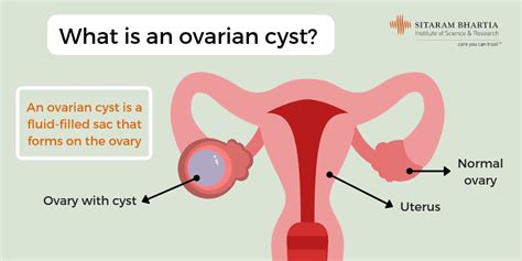 Cysts can vary in size from less than one centimeter (one-half inch) to greater than 10 centimeters (4 inches). . How much does a 5cm ovarian cyst weigh
